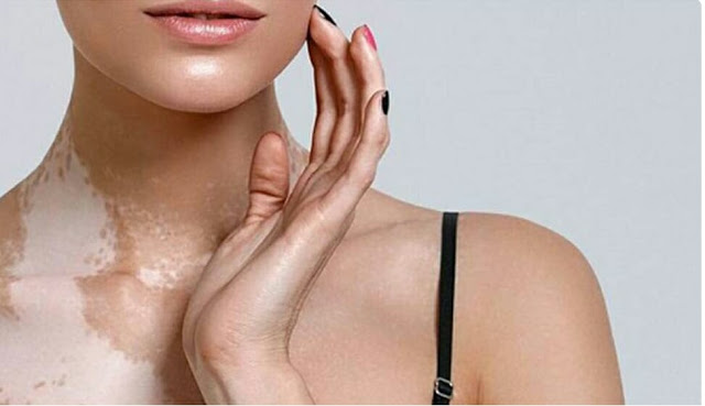 اليوم العالمي للبهاق تحت شعار "أنت أكثر جمالاً" اليوم العالمي للبهاق تحت شعار "أنت أكثر جمالاً"