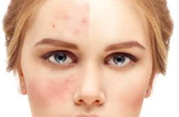 مرض بكتيريا الوجه مرض بكتيريا الوجه