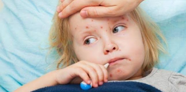 مرض الحصبة وأسبابها وطرق علاجها مرض الحصبة وأسبابها وطرق علاجها