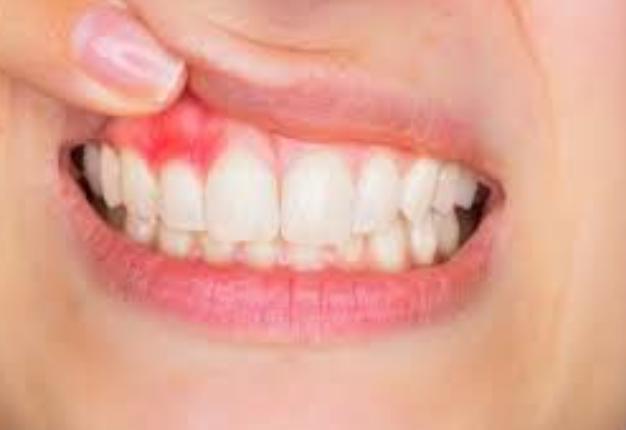 كيف تعرف التهاب اللثة وأسبابه؟