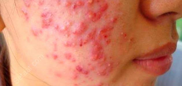 أسباب الدمامل وكيفية معالجتها