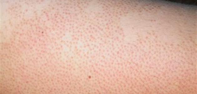 نصائح للتخلص من جلد الوزّة 