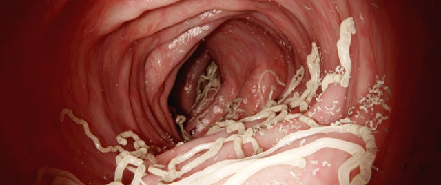 تعرف على كيفية علاج دود البطن