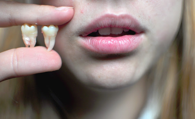 أضرار خلع ضرس العقل أضرار خلع ضرس العقل