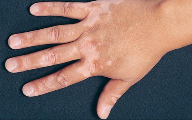 تعرف على مرض البهاق وأسبابه