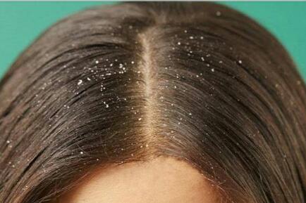 أسباب قشرة الشعر وعلاجها