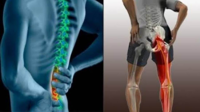 كل ما تريد معرفته عن عرق النسا وطرق العلاج