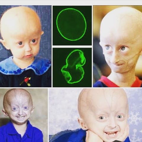 أخطر الأمراض على طفلك.. مرض الشيخوخة المبكرة للأطفال أخطر الأمراض على طفلك.. مرض الشيخوخة المبكرة للأطفال