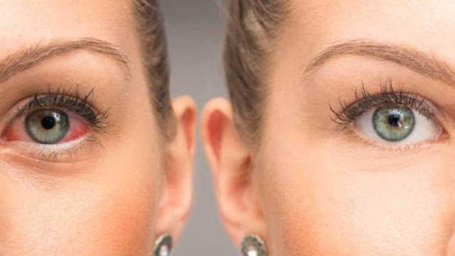 مرض جفاف العين مرض جفاف العين