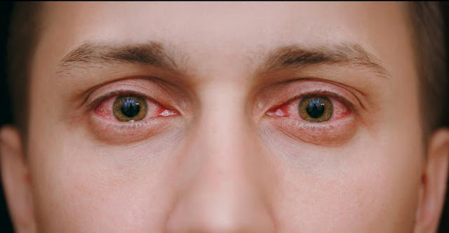 مرض الرمد الربيعي 