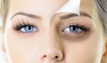 علاج الهالات السوداء