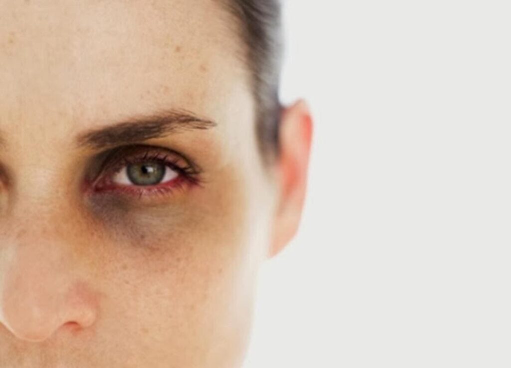 الهالات السوداء