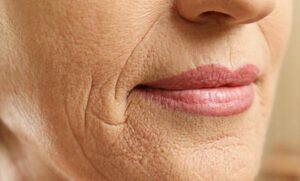 تجاعيد الوجه